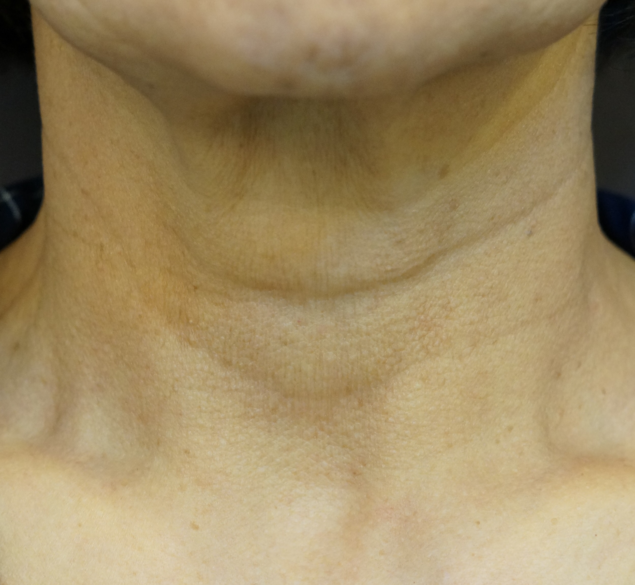 목주름 필러 Before