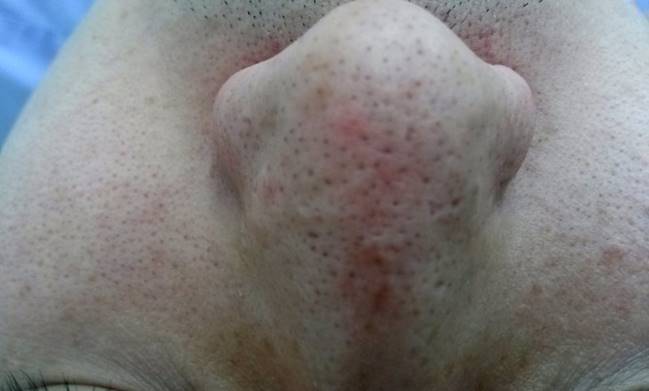 아피니트 코 블랙헤드 Before