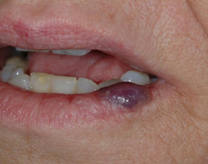 엑셀브이를 이용한 혈관종 치료  Before