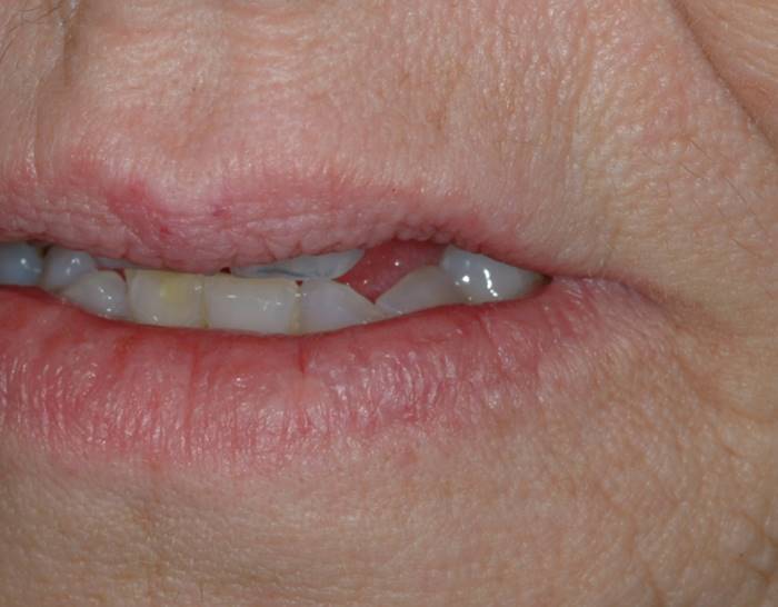 엑셀브이를 이용한 혈관종 치료  After