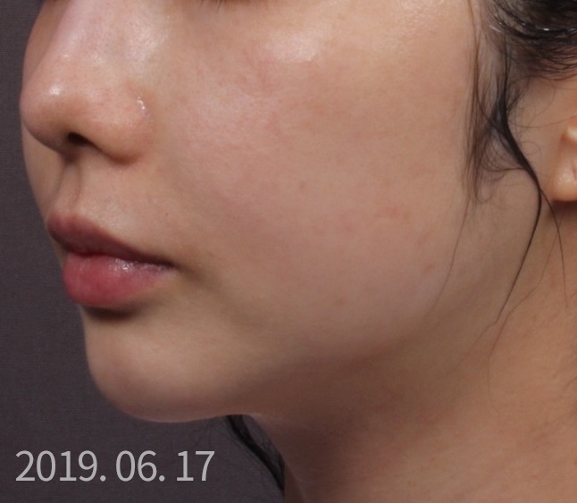 슈링크 + 토르 MPR 고주파 탄력 시술.. Before