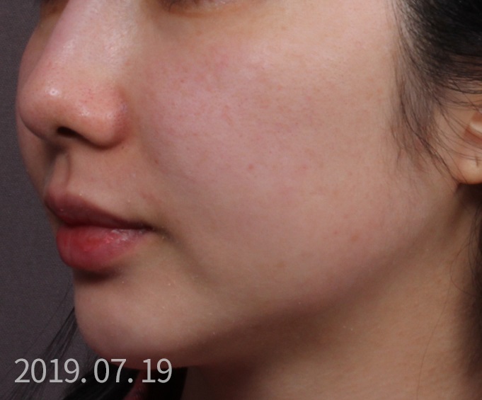 슈링크 + 토르 MPR 고주파 탄력 시술.. After