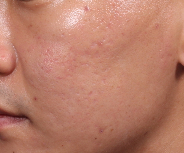 얼굴 여드름 흉터 After