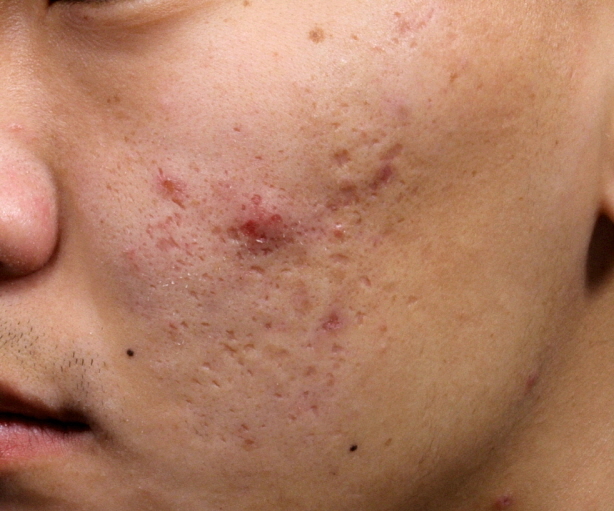 얼굴 여드름 흉터 Before