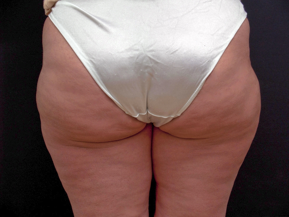 엑스웨이브 셀룰라이트 토닝 After