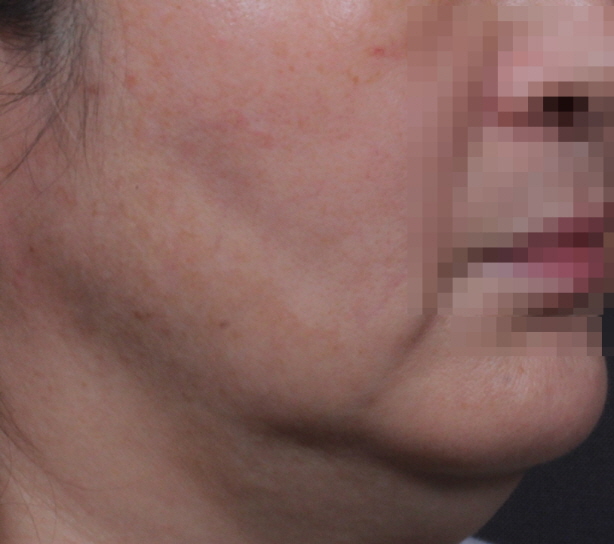 인모드 리프팅 Before