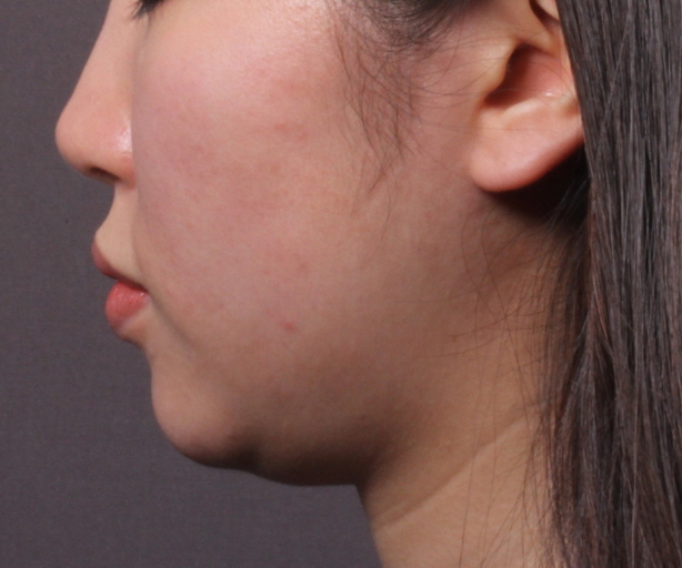 이중턱 민트실 리프팅 Before