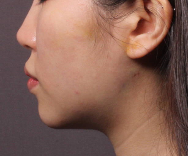 이중턱 민트실 리프팅 After