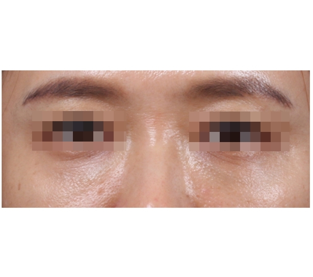 하안검 필러 (눈물고랑 필러) After