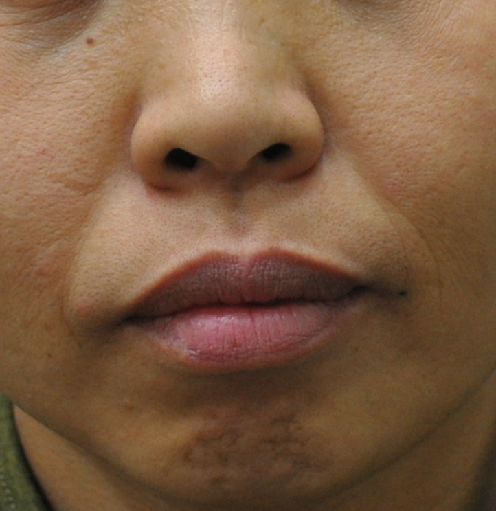 팔자 주름 스킨 필러 Before