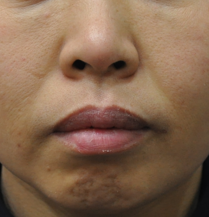 팔자 주름 스킨 필러 After