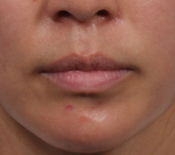 입술 필러 (레스틸렌 키스) Before