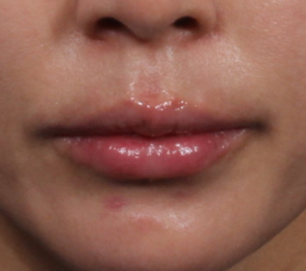 입술 필러 (레스틸렌 키스) After