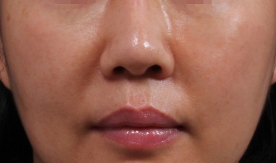 앞광대 필러 (인디언주름 필러) After