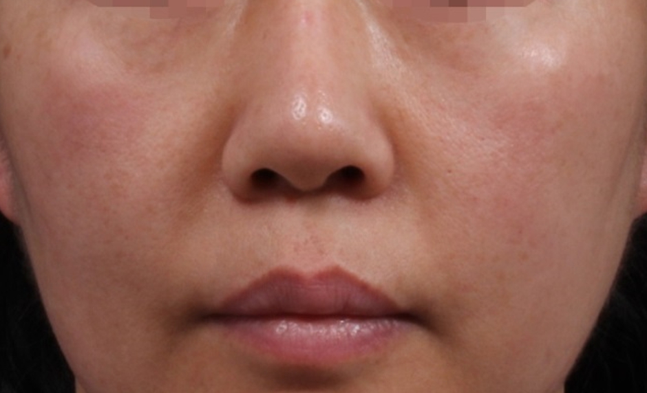 앞광대 필러 (인디언주름 필러) Before