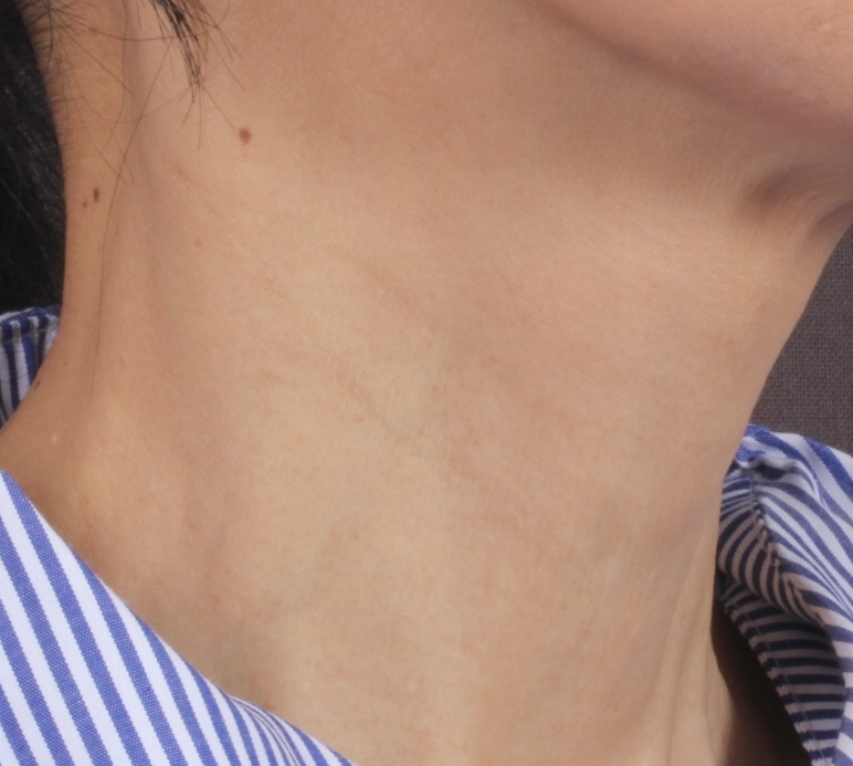 목주름 벨로테로 스킨필러 After