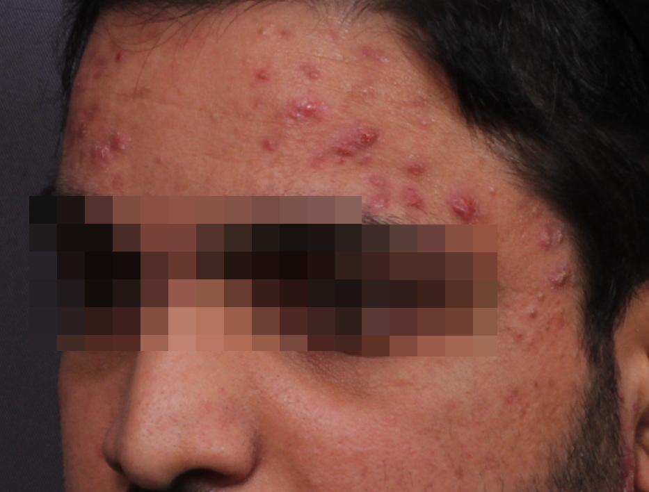 화농성 여드름 게어 Before