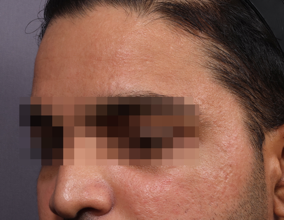 화농성 여드름 게어 After