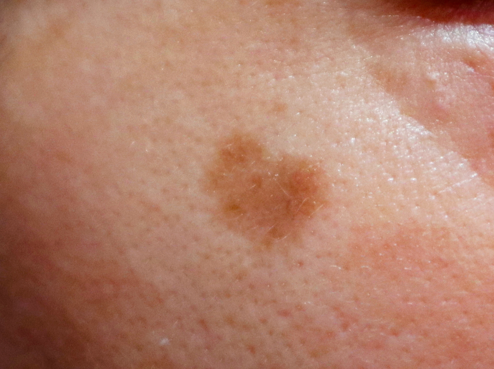 젠틀맥스프로플러스를 이용한 흑자 치료.. Before