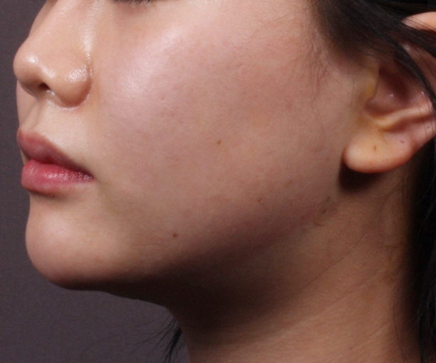 턱라인 실루엣소프트 리프팅 After