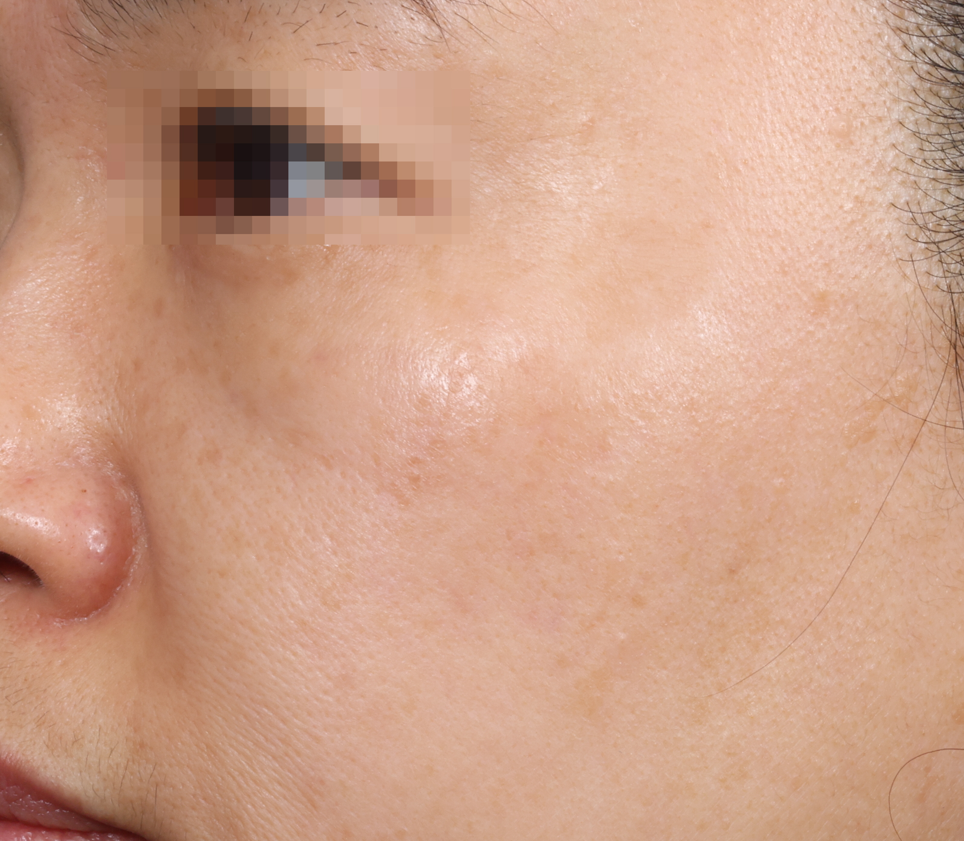 흑자 및 양측성 오타모반 토닝 치료.. After