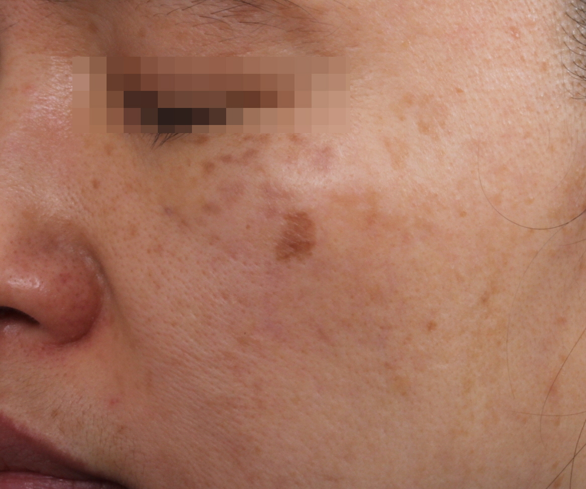 흑자 및 양측성 오타모반 토닝 치료.. Before