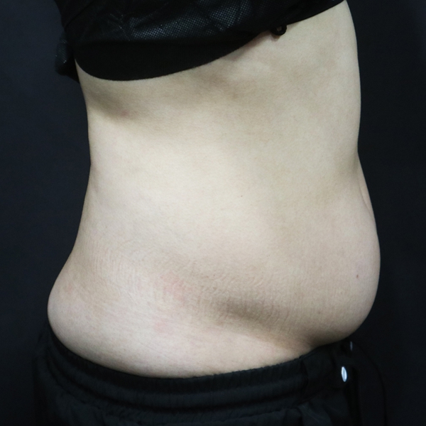 쓱팻 (아랫배) Before