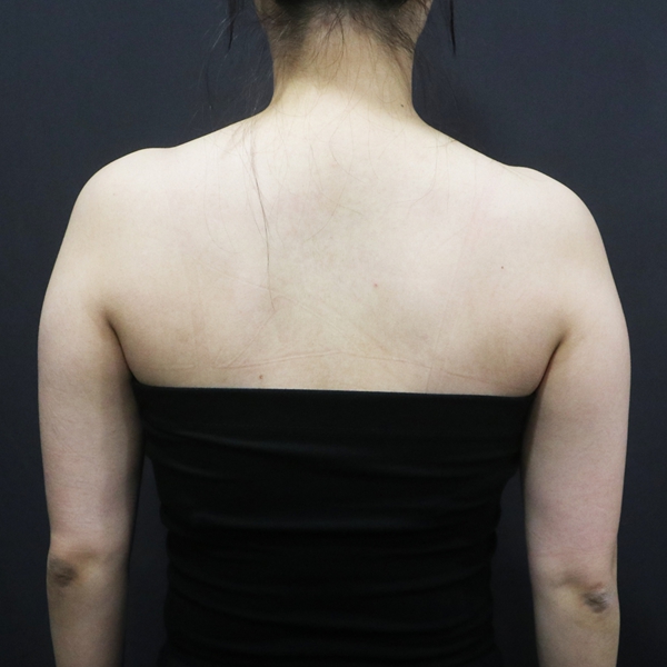 쓱팻 (팔뚝) Before