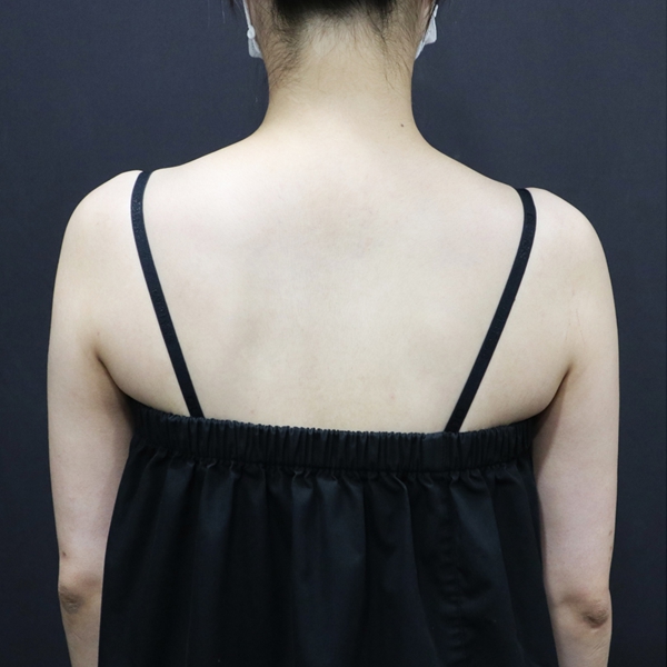 쓱팻 (팔뚝) After