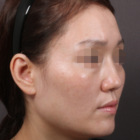 볼 꺼짐 필러 Before