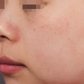 아리아 IPL을 이용한 색소 치료 After