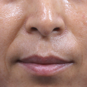 필러를 이용한 팔자 주름 교정 Before