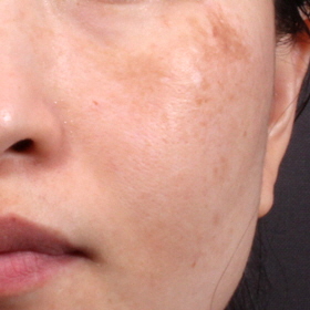 기미 치료 Before