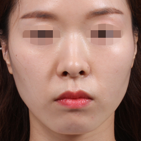 사각턱 보톡스 After