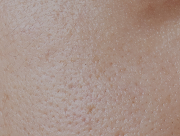 세인트클리닉 모공클리닉