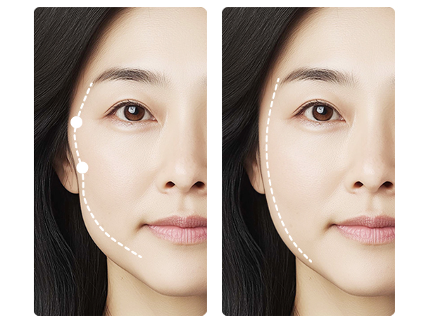 세인트클리닉 퀵 광대 축소 프로그램