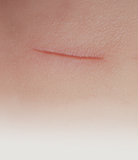 커스텀 흉터 프로그램