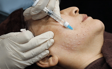 쥬브젠 자가진피재생술, 깊..