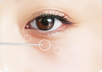 고주파 캐뉼라 시술